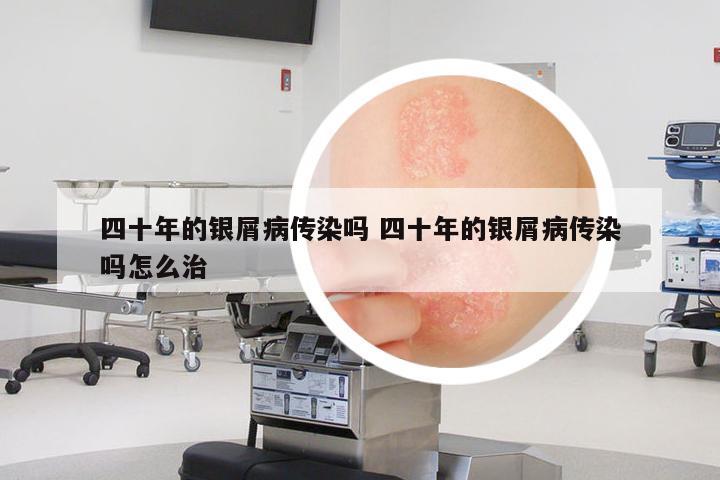 四十年的銀屑病傳染嗎 四十年的銀屑病傳染嗎怎么治