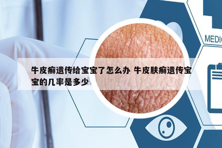 牛皮癬遺傳給寶寶了怎么辦 牛皮膚癬遺傳寶寶的幾率是多少