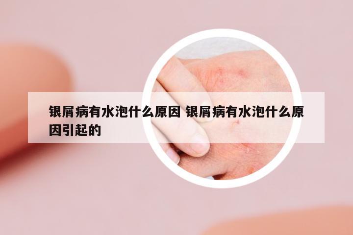 銀屑病有水泡什么原因 銀屑病有水泡什么原因引起的