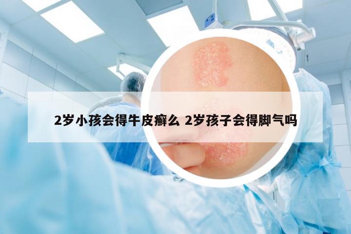 2歲小孩會得牛皮癬么 2歲孩子會得腳氣嗎