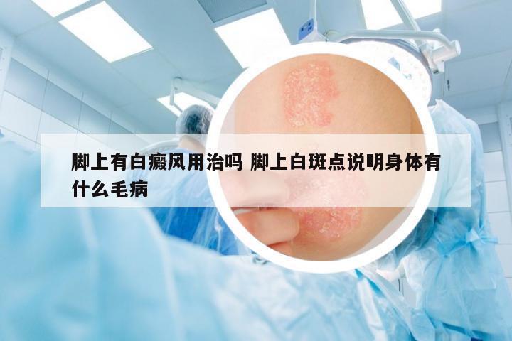 腳上有白癜風(fēng)用治嗎 腳上白斑點(diǎn)說(shuō)明身體有什么毛病