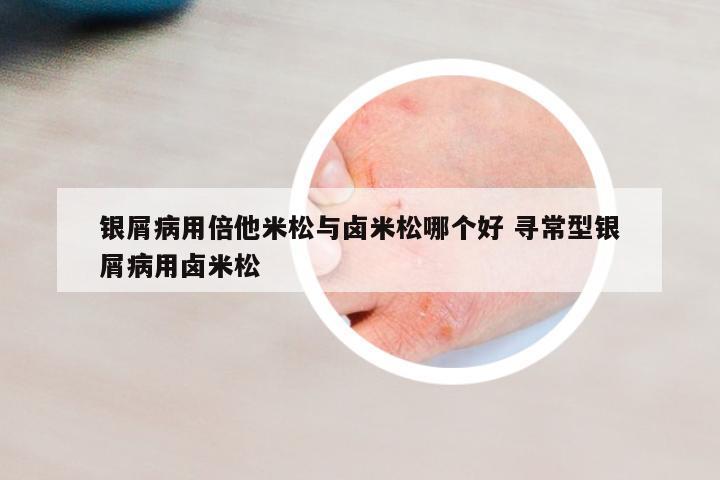 銀屑病用倍他米松與鹵米松哪個(gè)好 尋常型銀屑病用鹵米松