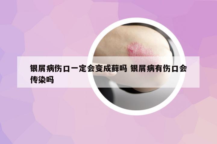 銀屑病傷口一定會變成蘚嗎 銀屑病有傷口會傳染嗎
