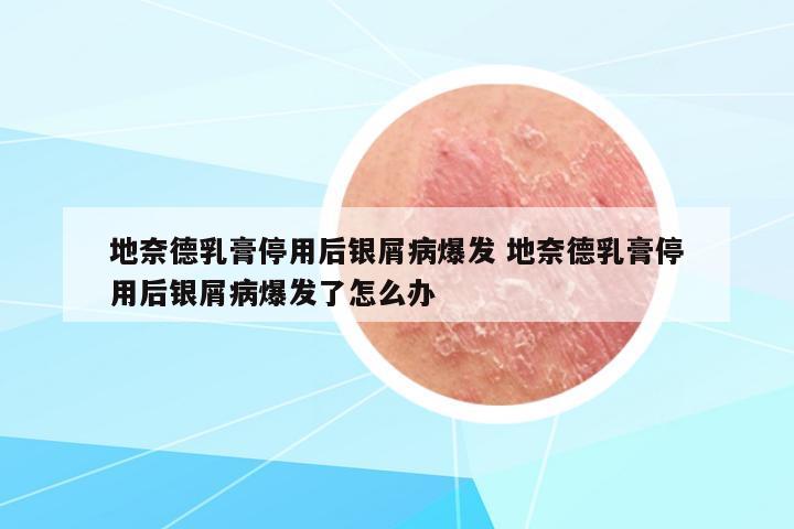 地奈德乳膏停用后銀屑病爆發(fā) 地奈德乳膏停用后銀屑病爆發(fā)了怎么辦