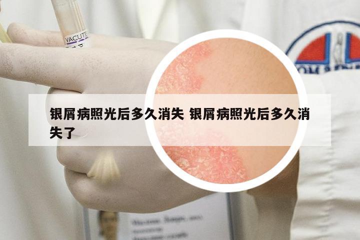 銀屑病照光后多久消失 銀屑病照光后多久消失了