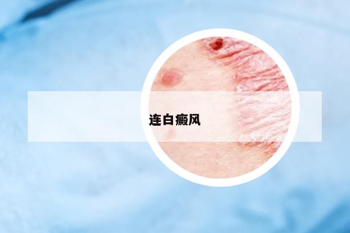 連白癜風(fēng)