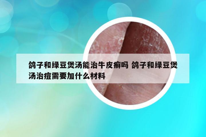 鴿子和綠豆煲湯能治牛皮癬嗎 鴿子和綠豆煲湯治痘需要加什么材料