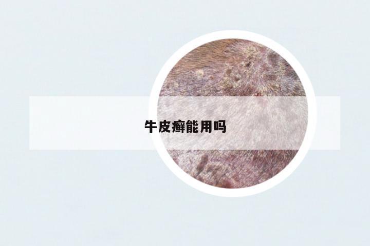 牛皮癬能用嗎