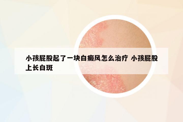 小孩屁股起了一塊白癜風(fēng)怎么治療 小孩屁股上長(zhǎng)白斑