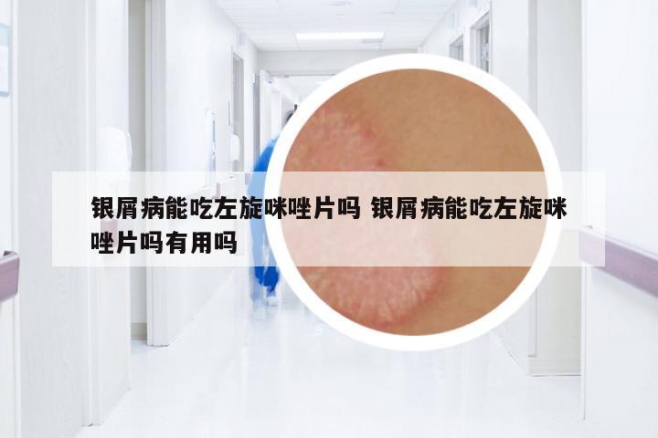 銀屑病能吃左旋咪唑片嗎 銀屑病能吃左旋咪唑片嗎有用嗎