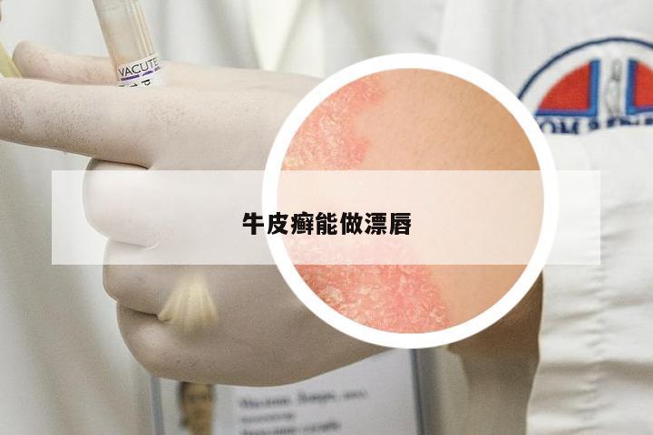 牛皮癬能做漂唇
