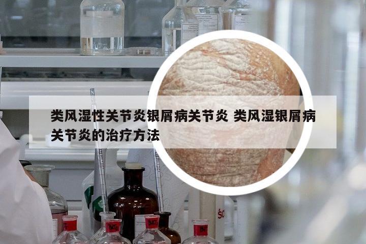 類風濕性關節(jié)炎銀屑病關節(jié)炎 類風濕銀屑病關節(jié)炎的治療方法