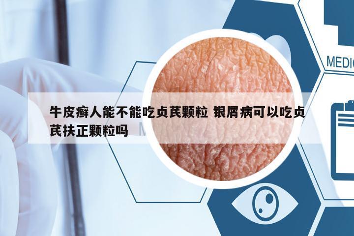 牛皮癬人能不能吃貞芪顆粒 銀屑病可以吃貞芪扶正顆粒嗎