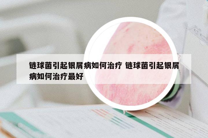 鏈球菌引起銀屑病如何治療 鏈球菌引起銀屑病如何治療最好