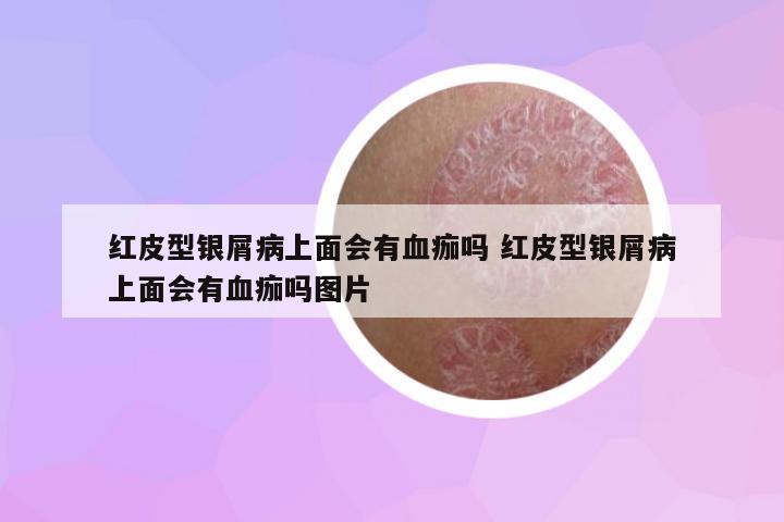 紅皮型銀屑病上面會(huì)有血痂嗎 紅皮型銀屑病上面會(huì)有血痂嗎圖片