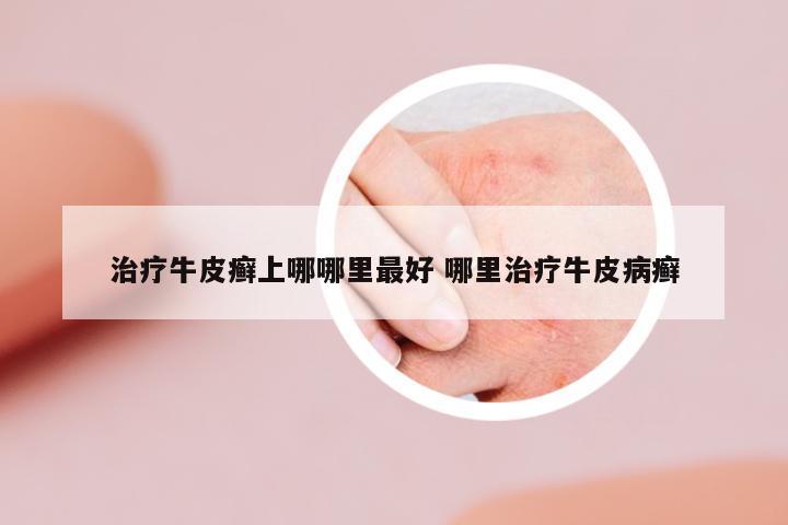 治療牛皮癬上哪哪里最好 哪里治療牛皮病癬