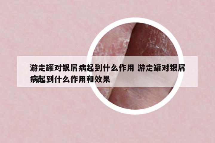 游走罐對銀屑病起到什么作用 游走罐對銀屑病起到什么作用和效果