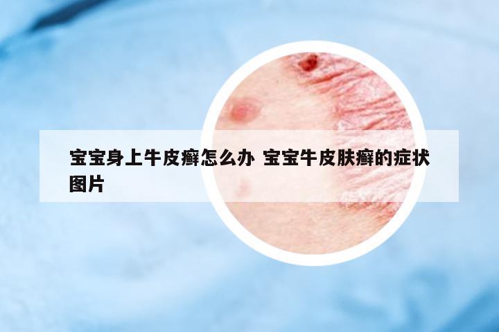 寶寶身上牛皮癬怎么辦 寶寶牛皮膚癬的癥狀圖片