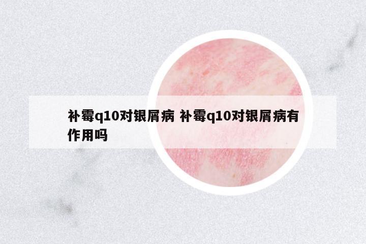 補霉q10對銀屑病 補霉q10對銀屑病有作用嗎