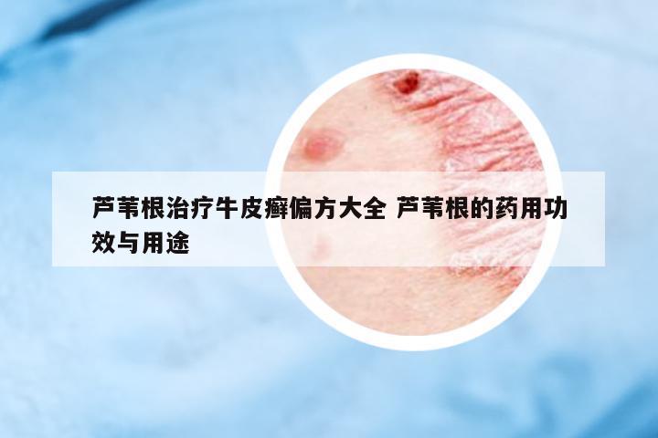 蘆葦根治療牛皮癬偏方大全 蘆葦根的藥用功效與用途