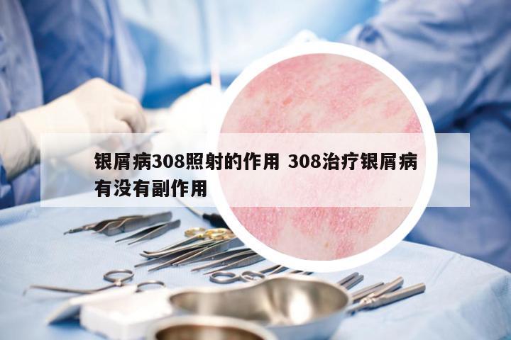 銀屑病308照射的作用 308治療銀屑病有沒(méi)有副作用