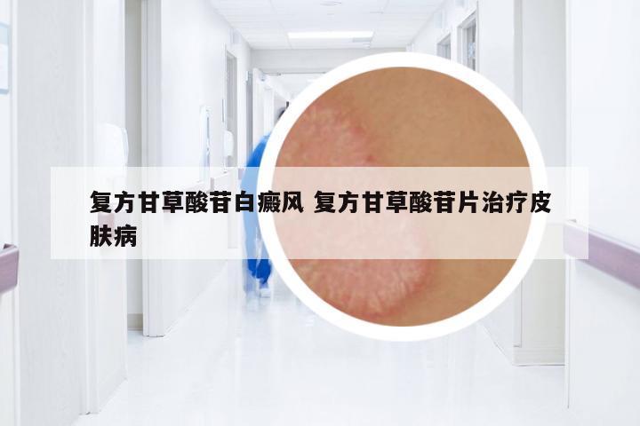 復(fù)方甘草酸苷白癜風(fēng) 復(fù)方甘草酸苷片治療皮膚病
