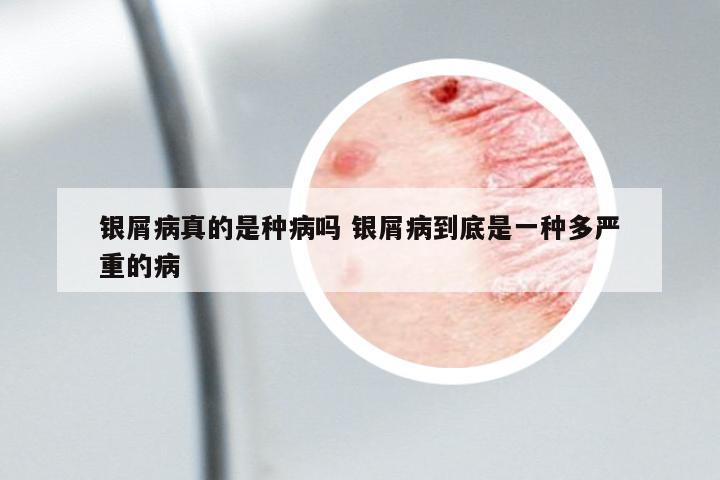 銀屑病真的是種病嗎 銀屑病到底是一種多嚴(yán)重的病