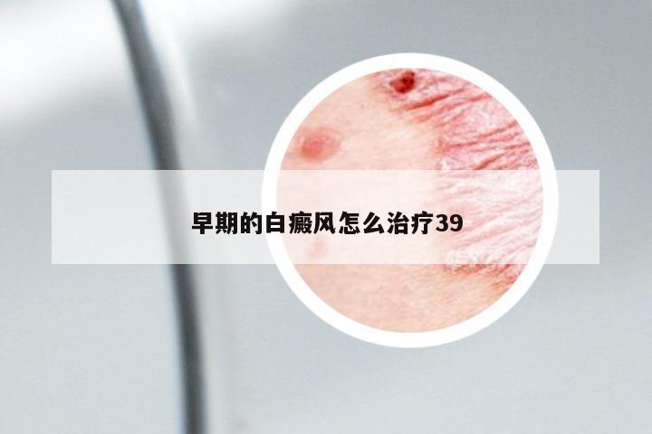 早期的白癜風(fēng)怎么治療39