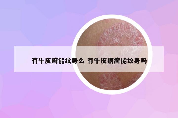 有牛皮癬能紋身么 有牛皮病癬能紋身嗎