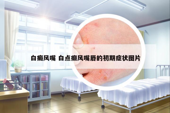 白癜風(fēng)嘴 白點(diǎn)癲風(fēng)嘴唇的初期癥狀圖片