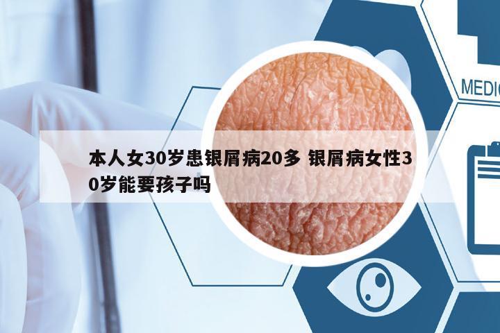 本人女30歲患銀屑病20多 銀屑病女性30歲能要孩子嗎