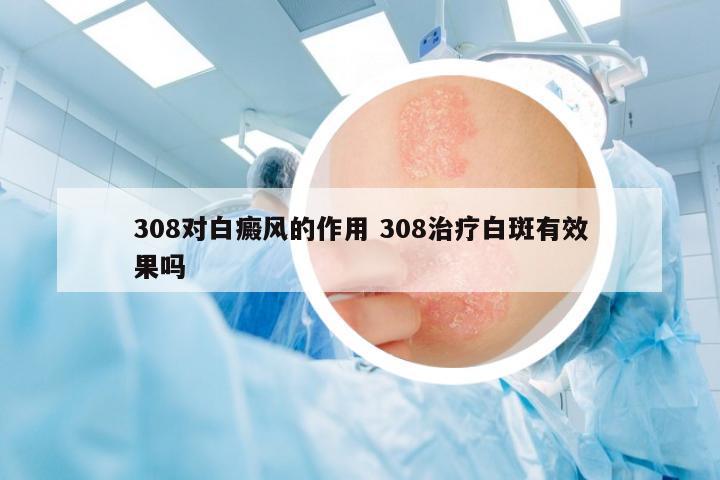 308對(duì)白癜風(fēng)的作用 308治療白斑有效果嗎