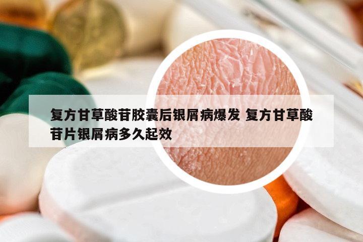 復(fù)方甘草酸苷膠囊后銀屑病爆發(fā) 復(fù)方甘草酸苷片銀屑病多久起效