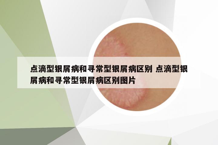 點滴型銀屑病和尋常型銀屑病區(qū)別 點滴型銀屑病和尋常型銀屑病區(qū)別圖片