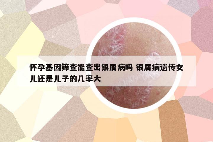 懷孕基因篩查能查出銀屑病嗎 銀屑病遺傳女兒還是兒子的幾率大