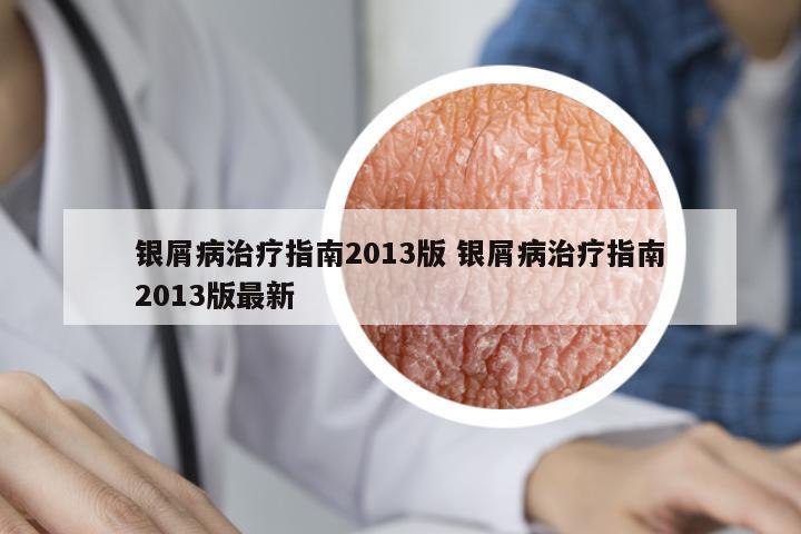 銀屑病治療指南2013版 銀屑病治療指南2013版最新