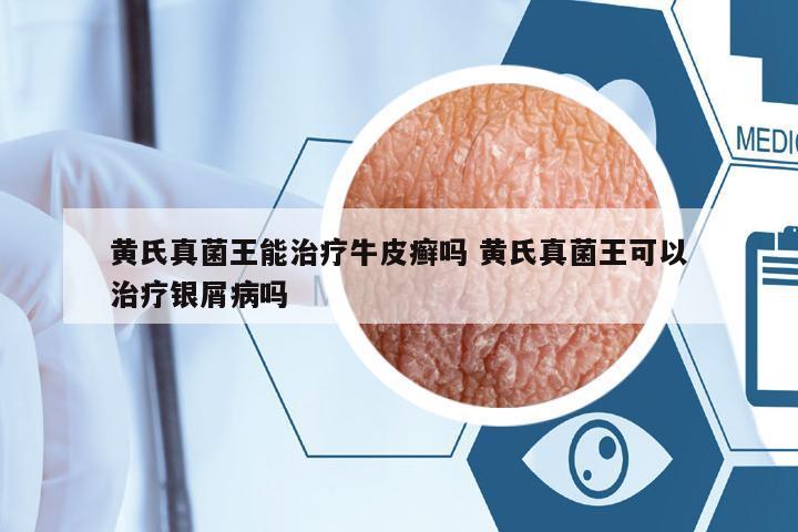 黃氏真菌王能治療牛皮癬嗎 黃氏真菌王可以治療銀屑病嗎