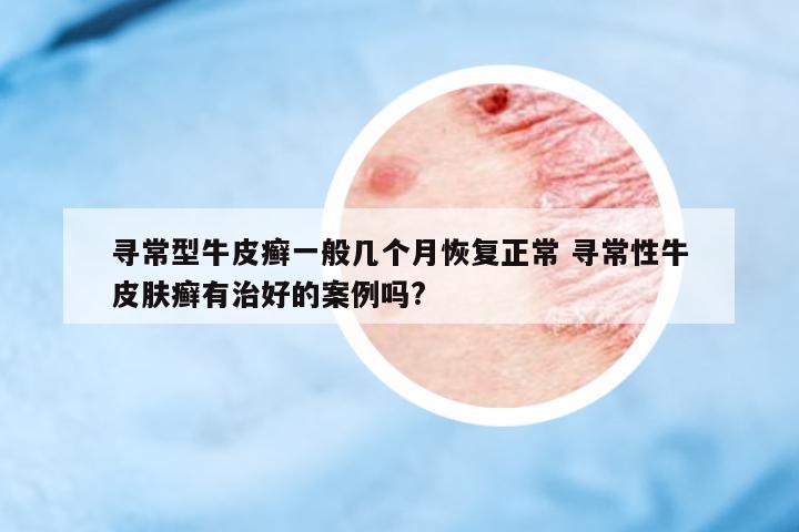 尋常型牛皮癬一般幾個(gè)月恢復(fù)正常 尋常性牛皮膚癬有治好的案例嗎?