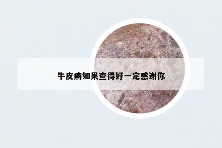 牛皮癬如果查得好一定感謝你