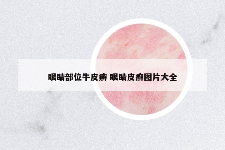 眼睛部位牛皮癬 眼睛皮癬圖片大全