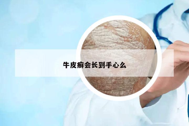 牛皮癬會(huì)長(zhǎng)到手心么
