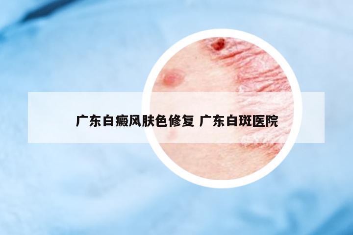 廣東白癜風(fēng)膚色修復(fù) 廣東白斑醫(yī)院