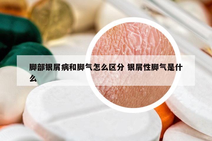 腳部銀屑病和腳氣怎么區(qū)分 銀屑性腳氣是什么