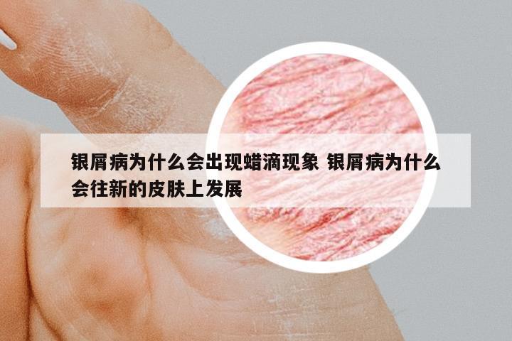 銀屑病為什么會出現(xiàn)蠟滴現(xiàn)象 銀屑病為什么會往新的皮膚上發(fā)展