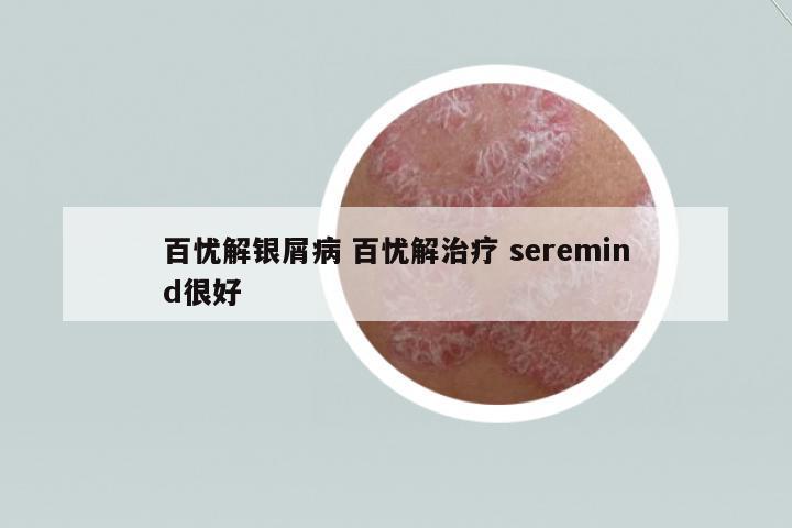 百憂解銀屑病 百憂解治療 seremind很好