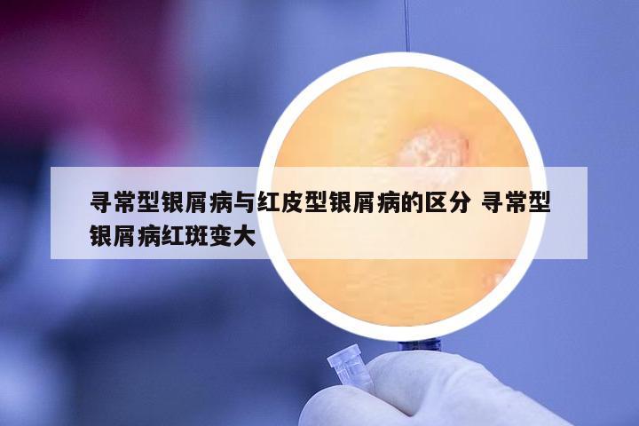 尋常型銀屑病與紅皮型銀屑病的區(qū)分 尋常型銀屑病紅斑變大