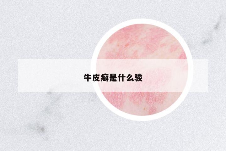 牛皮癬是什么駿