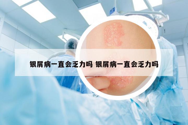 銀屑病一直會(huì)乏力嗎 銀屑病一直會(huì)乏力嗎