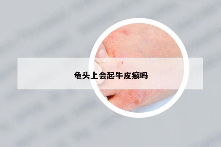 龜頭上會起牛皮癬嗎