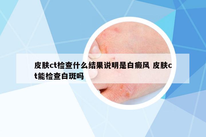 皮膚ct檢查什么結(jié)果說明是白癜風(fēng) 皮膚ct能檢查白斑嗎